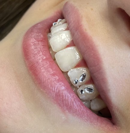 Strass dentaire